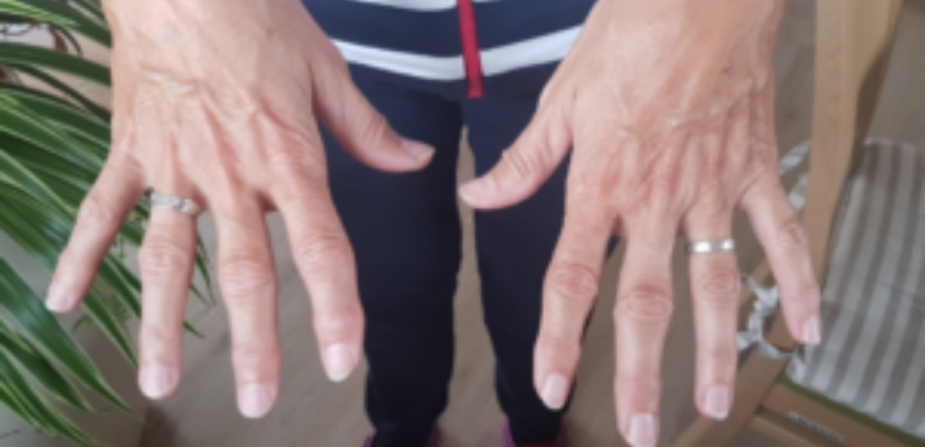artroza-prstov-na-rokah