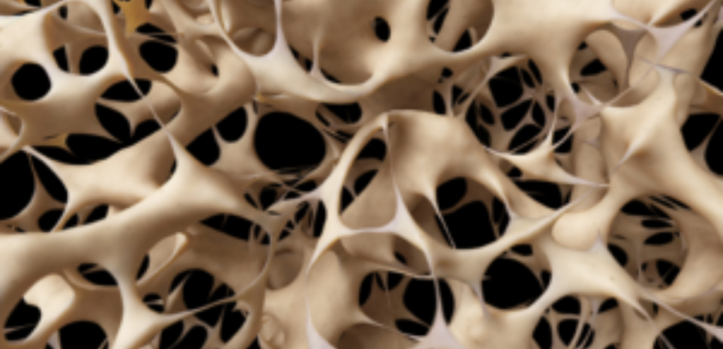 osteoporoza vzrok za bolecine v kolkih