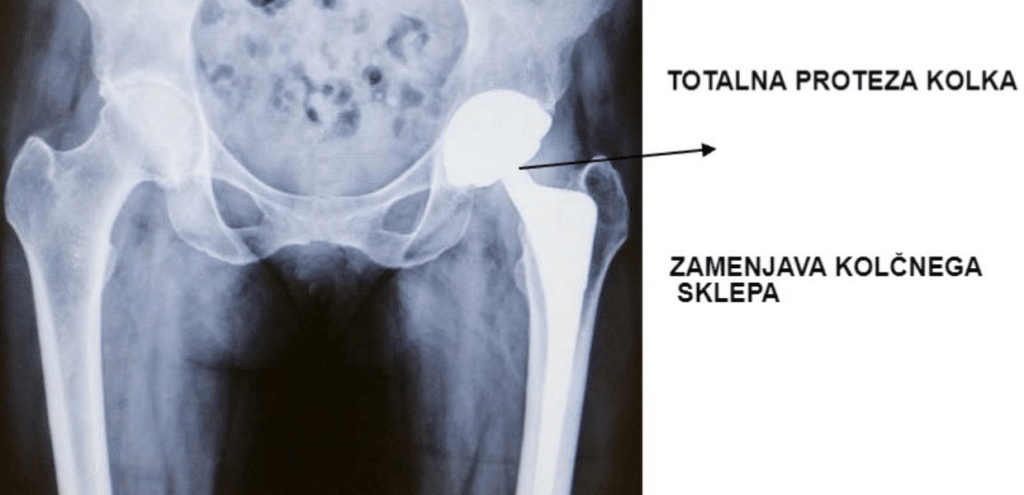 totalna-proteza-kolka