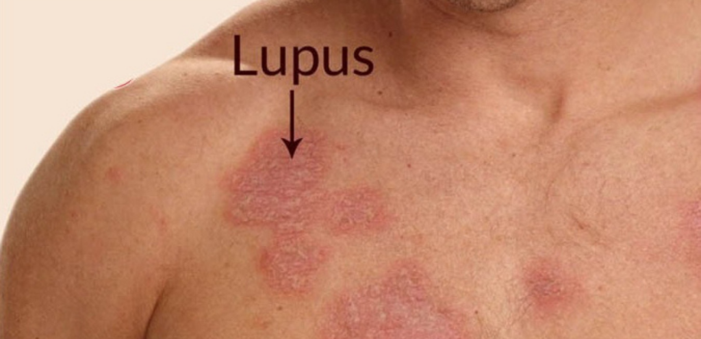 Lupus je vrsta artritisa, ki napade kožo.