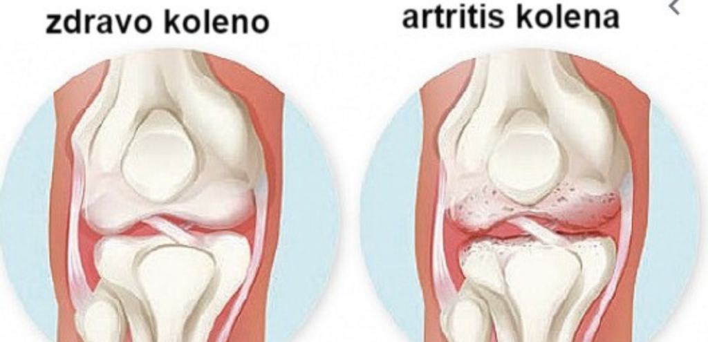 artritis-v-kolenu