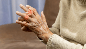 kaj je psoriaticni artritis