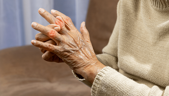 kaj je psoriaticni artritis