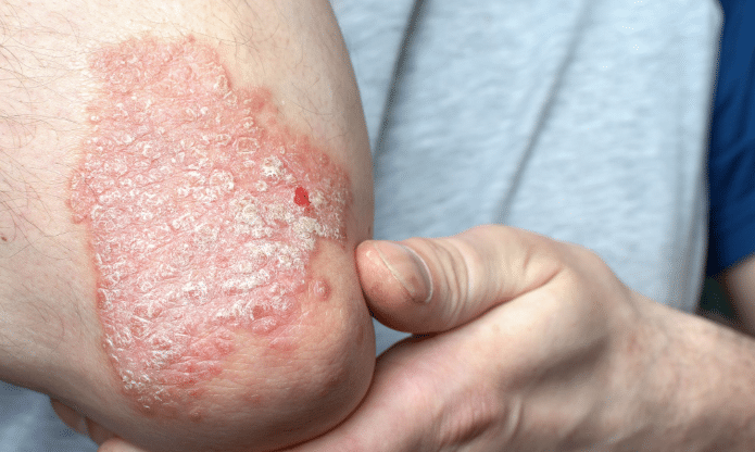 psoriatični artritis