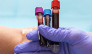 revmatoidni artritis vrednosti